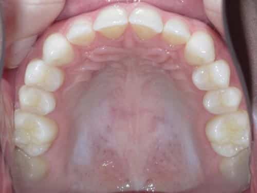 Online Smile Assessment Occlusal Photo of Maxillary Dentition