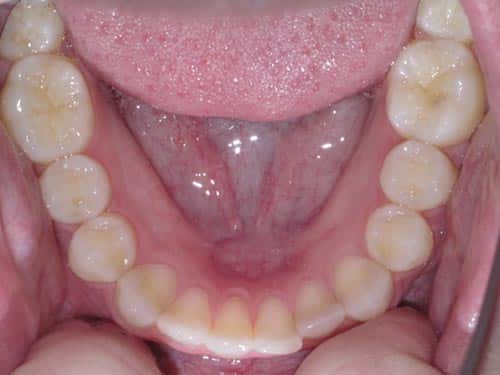 Online Smile Assessment Occlusal Photo of Mandibular Dentition
